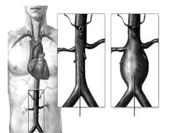 腹主動脈瘤